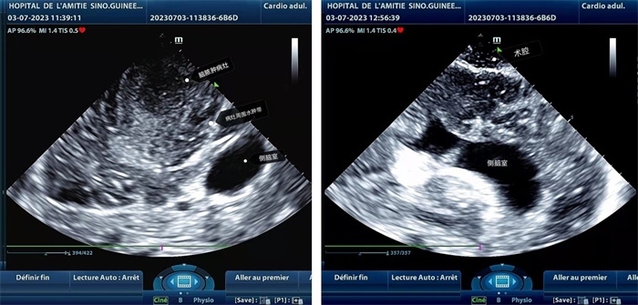 左圖顯示術(shù)中超聲見囊實性病變，大小約為4x4x3cm，病灶周圍腦組織水腫明顯；右圖為病灶切除后，術(shù)中超聲示術(shù)腔無病變殘留