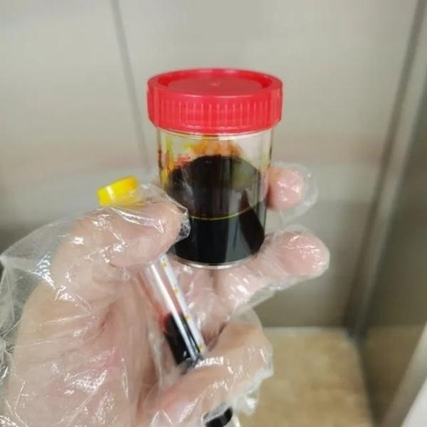 急性肝衰竭！兩兄弟誤吃這種菌 專家提醒