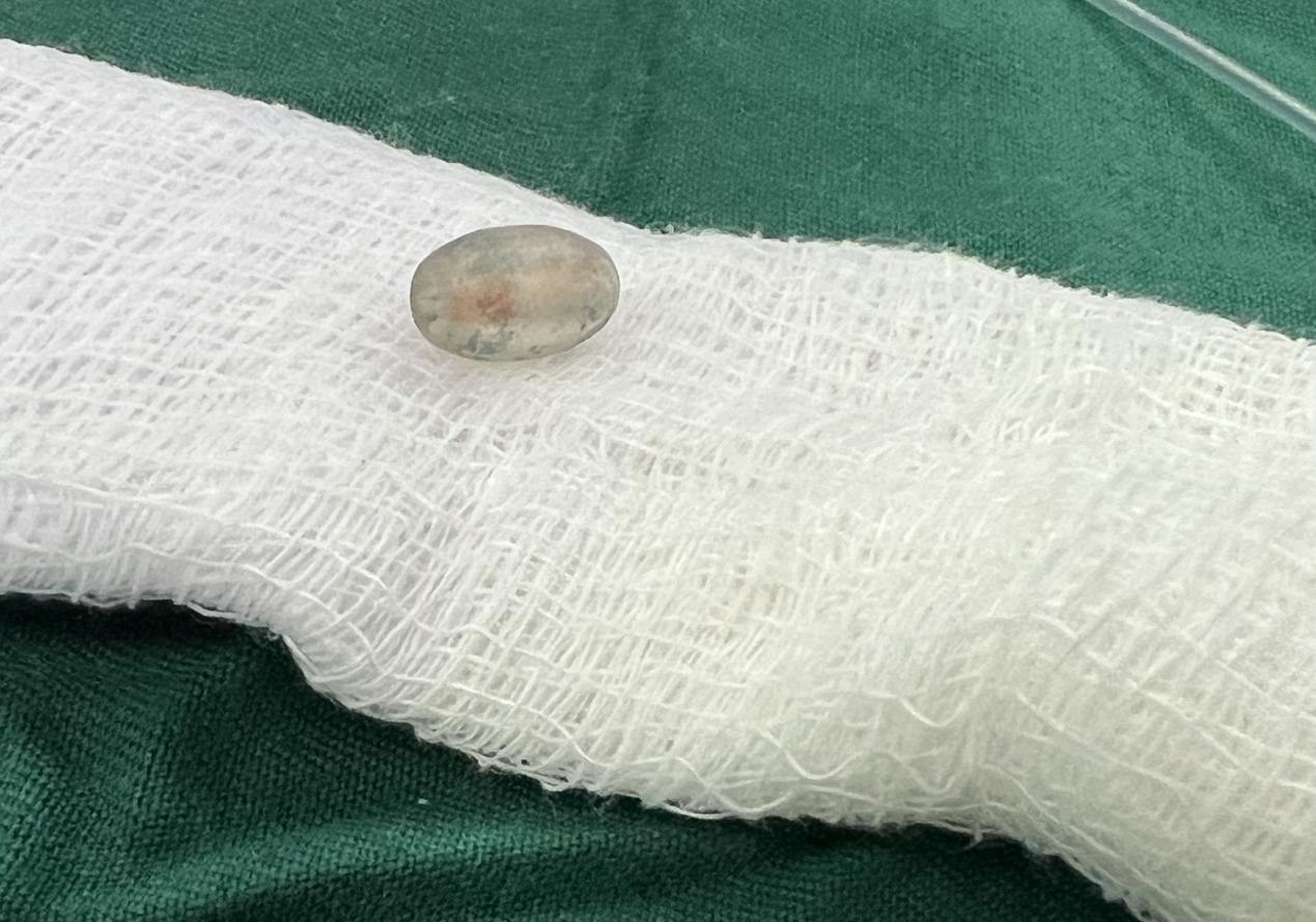 被取出的異物。中國援桑醫(yī)療隊(duì)供圖