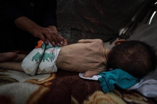 這是5月28日在加沙城西部一處臨時安置點拍攝的一名營養(yǎng)不良的嬰兒。新華社發(fā)（馬哈茂德·扎基攝）